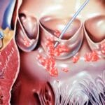 endocarditis