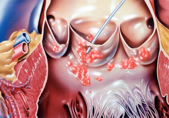 endocarditis