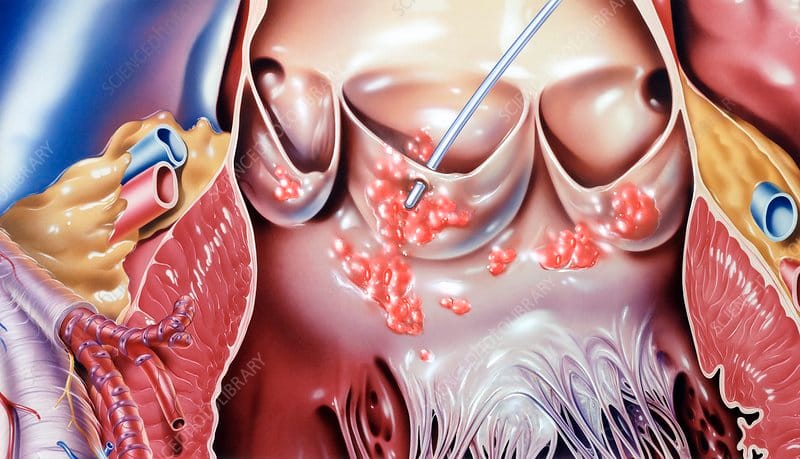 endocarditis