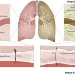 interstitial lung disease