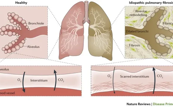 interstitial lung disease