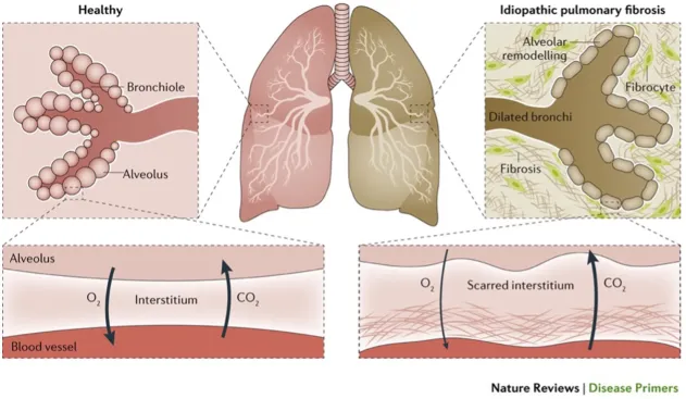 interstitial lung disease