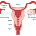 Polycystic Ovary Syndrome