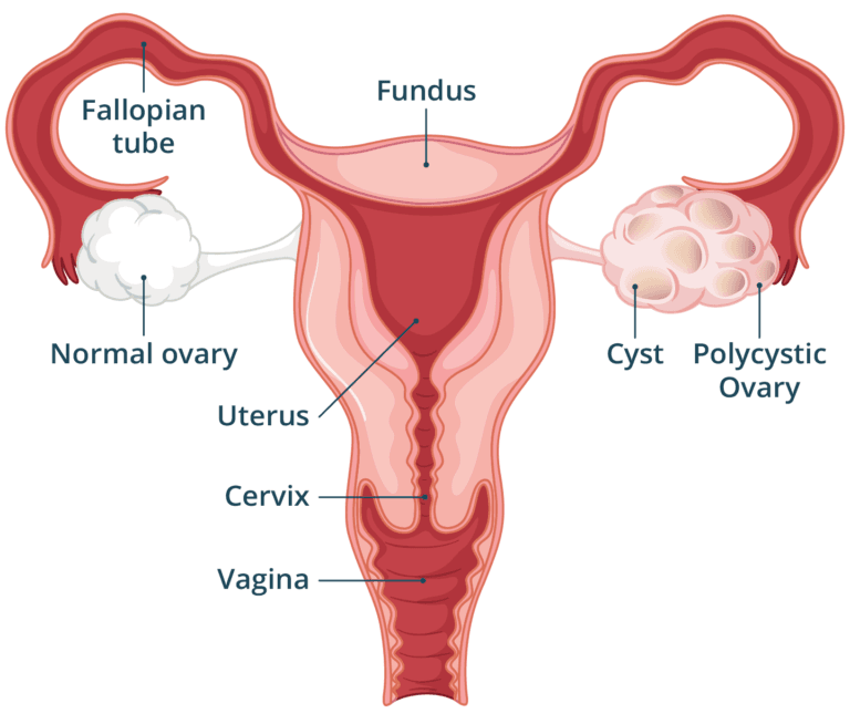 Polycystic Ovary Syndrome